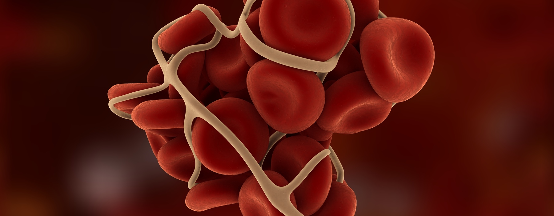 THROMBOSIS BANNER - Καρωτιδική νόσος