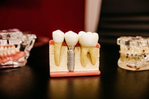 jonathan borba W9YEY6G8LVM unsplash 300x200 - MEDITERRANEO FIRST CARE DENTAL